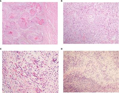 Clinicopathological and Prognostic Characteristics of Esophageal Spindle Cell Squamous Cell Carcinoma: An Analysis of 43 Patients in a Single Center